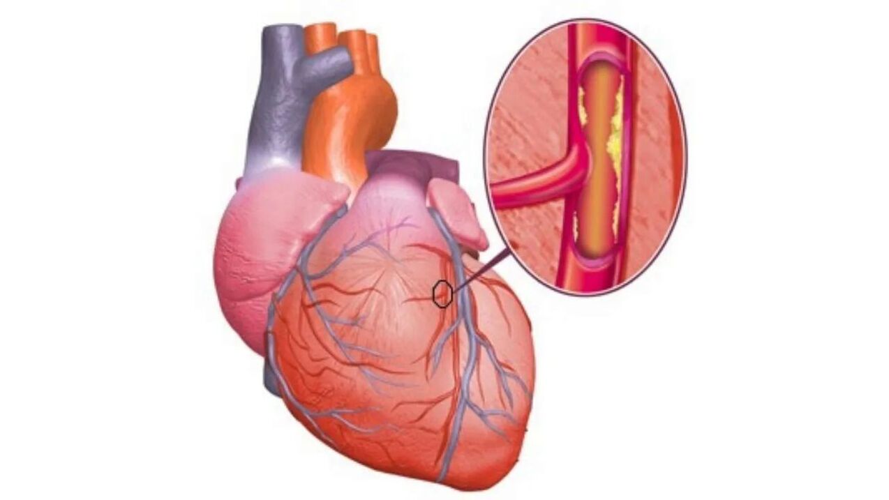 Heart problems caused by high blood pressure