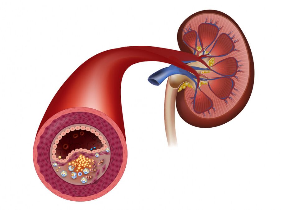 Reduce blood flow caused by atherosclerosis